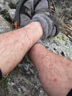 Black Fly Bites